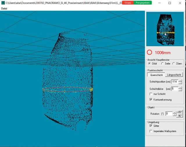 Abb. 6: Punktwolke in der orbitalen Ansicht mit Ergebnis der automatischen Konturerkennung: Der Durchmesser der Kreiskontur beträgt 1.006 mm (rot angegeben), die betreffende Querschichtposition ist innerhalb der Punktewolke gelb dargestellt.